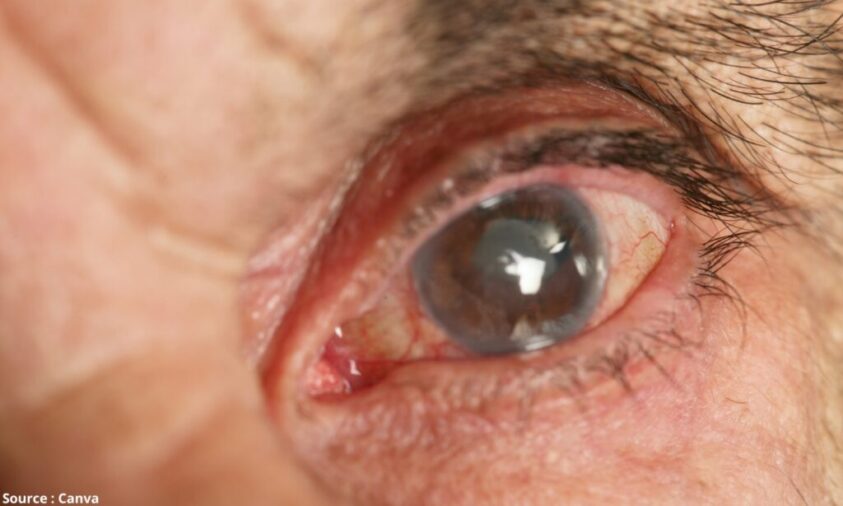 biaya operasi katarak