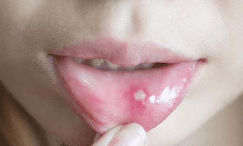 Tips Efektif Mengatasi Sariawan