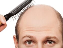 3 Cara Ampuh Mengatasi Kebotakan Rambut di Usia Dini dari Ahlinya