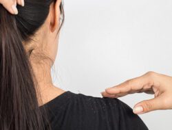 Rahasia Kulit Kepala Sehat: Cara Mengurangi Ketombe