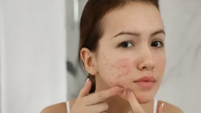 5 Tips Mencegah Purging Saat Menggunakan Skincare Baru