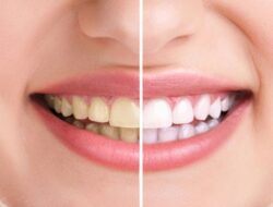 Gigi Lebih Putih dan Bersih Alami, Coba 6 Cara Ini