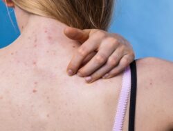 Jerawat di Badan Bikin Resah? Ini 4 Cara Ampuh Mengatasinya