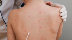 Tubuh Kecil di Tengah Wabah Lama yang Mengetuk Kembali