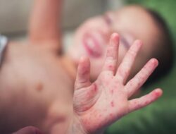 Campak Masih Mengancam, Kemenkes Ingatkan Hindari Kontak dengan Bayi Saat Sakit