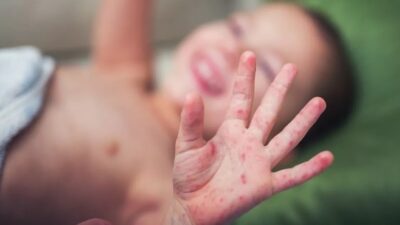 ancaman campak pada bayi