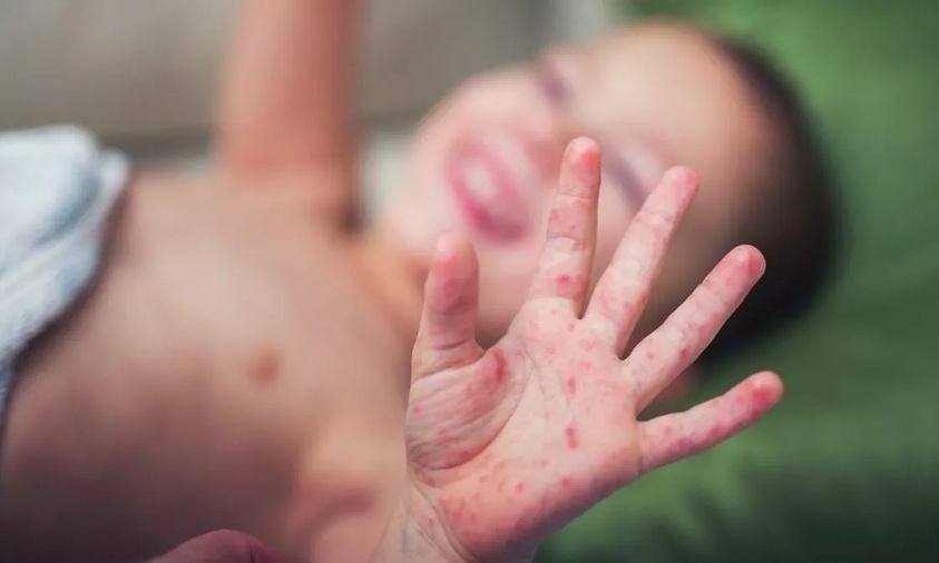 ancaman campak pada bayi